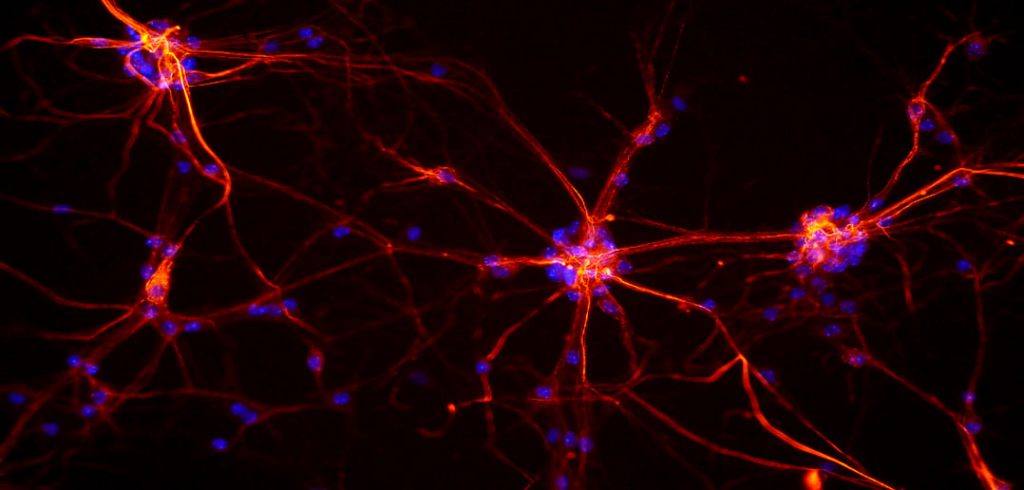 This brain protein may be the key to preventing the loss of dopamine neurons in Parkinson’s disease